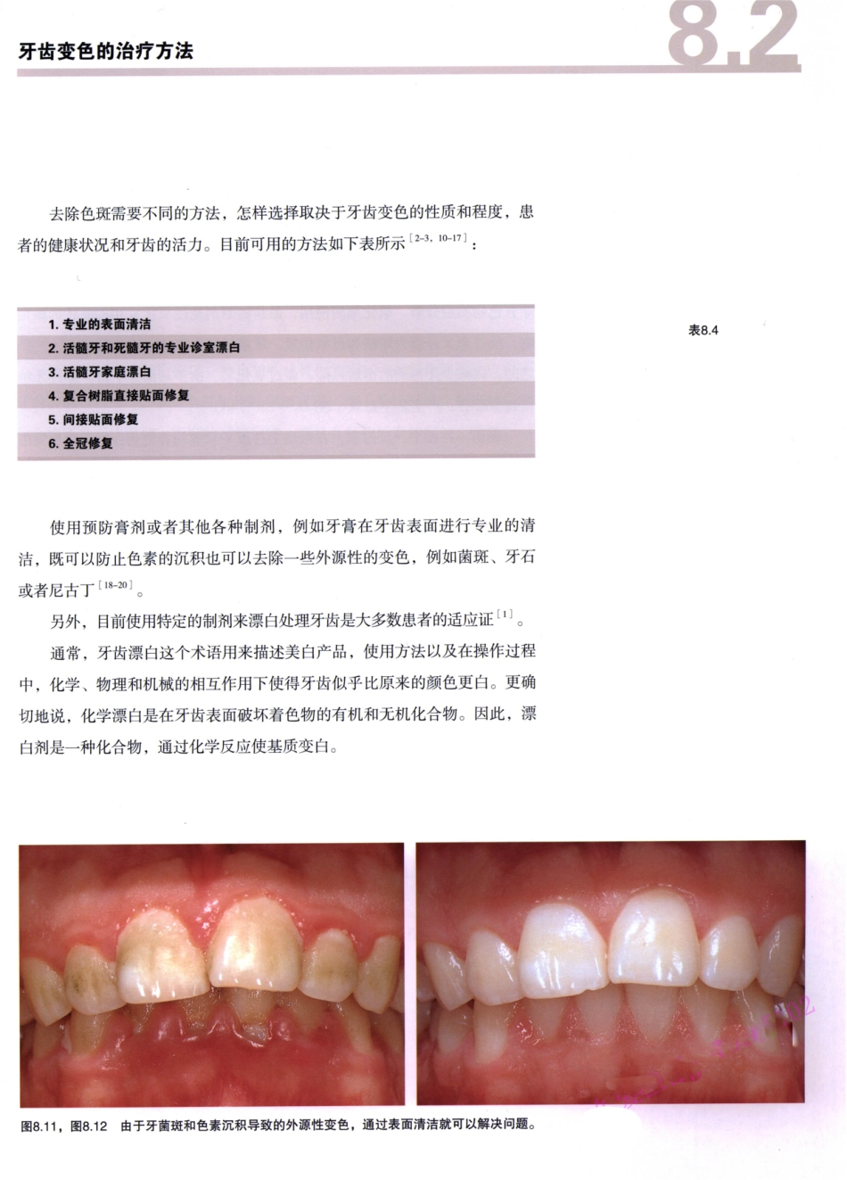 前牙微创美学修复（第2卷）_周锐2015（彩图）书签_331-345.pdf_第1页