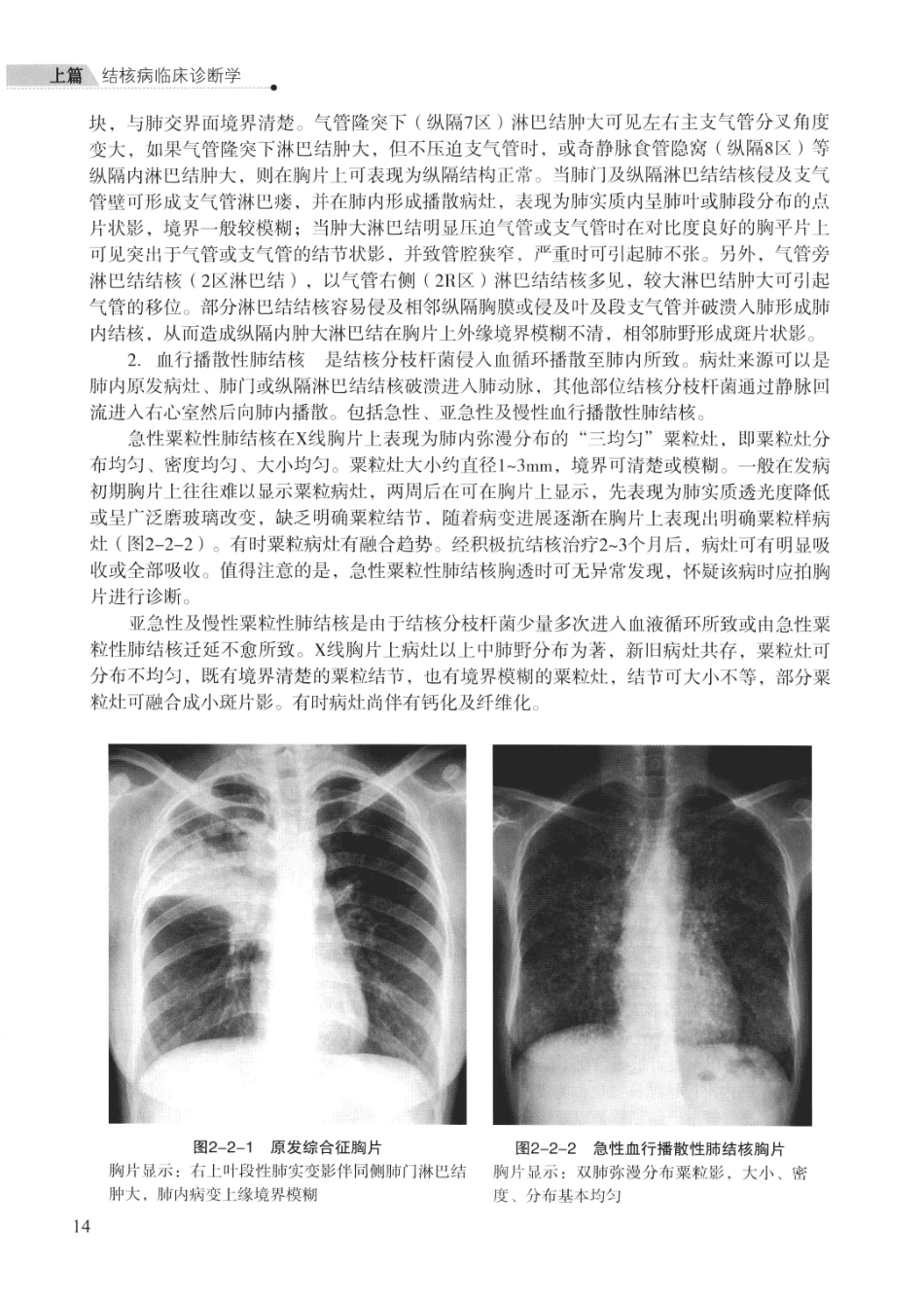 临床结核病学 （临床、影像、病例、误区及_13008036_26-50.pdf_第3页