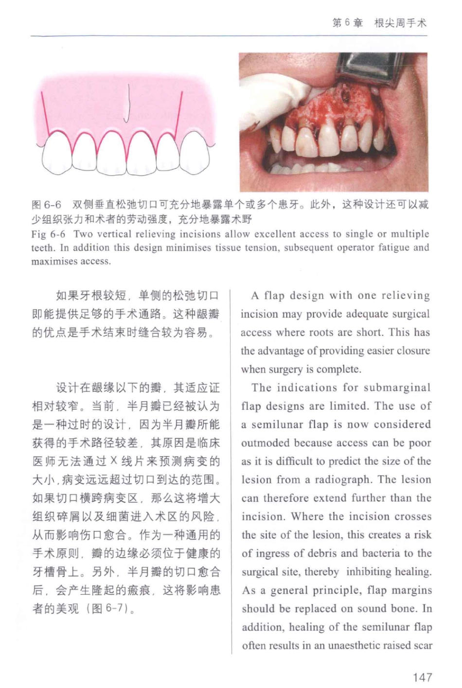 牙周手术临床指南 中英文对照_俞雪芬2013（彩图）_157-168.pdf_第1页