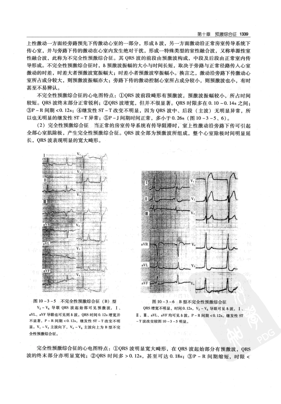 实用心律失常学：1100例心电图个案临床分析  第2版_中国协和医科大学出版社_2008.10_夏宏器，邓开伯主编_1351-1400.pdf_第1页