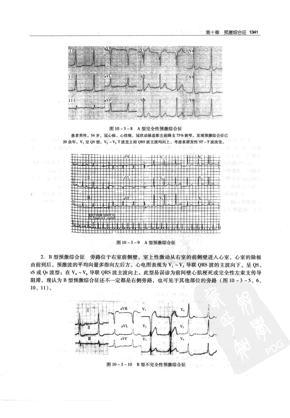 实用心律失常学：1100例心电图个案临床分析  第2版_中国协和医科大学出版社_2008.10_夏宏器，邓开伯主编_1351-1400.pdf_第3页