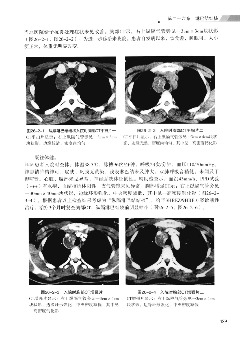 临床结核病学 （临床、影像、病例、误区及_13008036_501-525.pdf_第3页