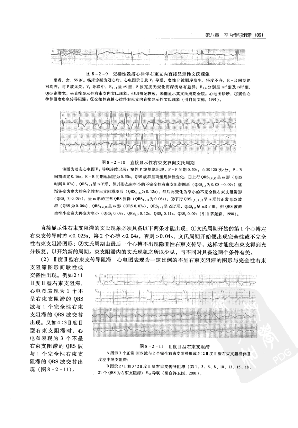 实用心律失常学：1100例心电图个案临床分析  第2版_中国协和医科大学出版社_2008.10_夏宏器，邓开伯主编_1101-1150.pdf_第3页
