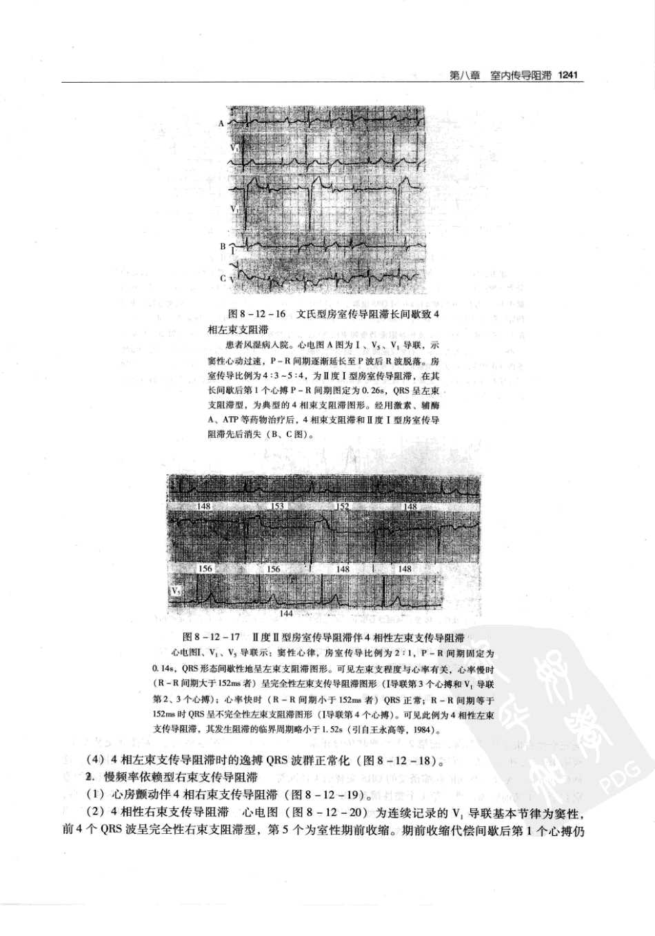 实用心律失常学：1100例心电图个案临床分析  第2版_中国协和医科大学出版社_2008.10_夏宏器，邓开伯主编_1251-1300.pdf_第3页