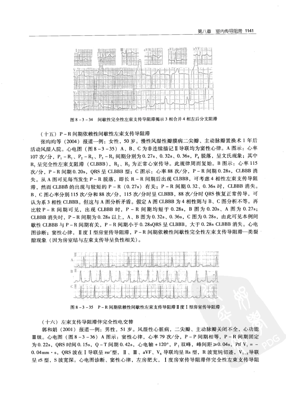 实用心律失常学：1100例心电图个案临床分析  第2版_中国协和医科大学出版社_2008.10_夏宏器，邓开伯主编_1151-1200.pdf_第3页