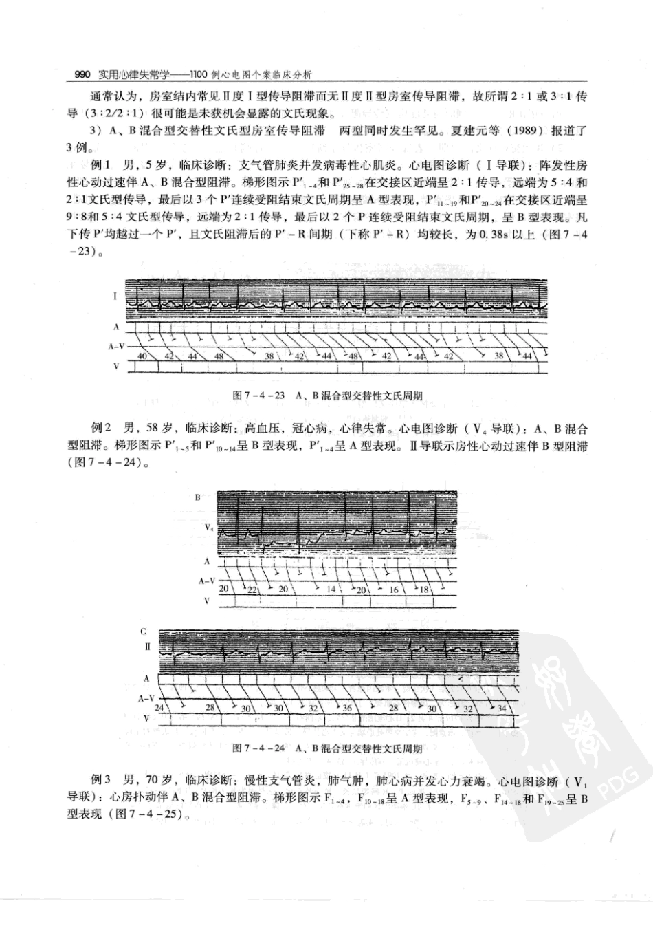 实用心律失常学：1100例心电图个案临床分析  第2版_中国协和医科大学出版社_2008.10_夏宏器，邓开伯主编_1001-1050.pdf_第2页