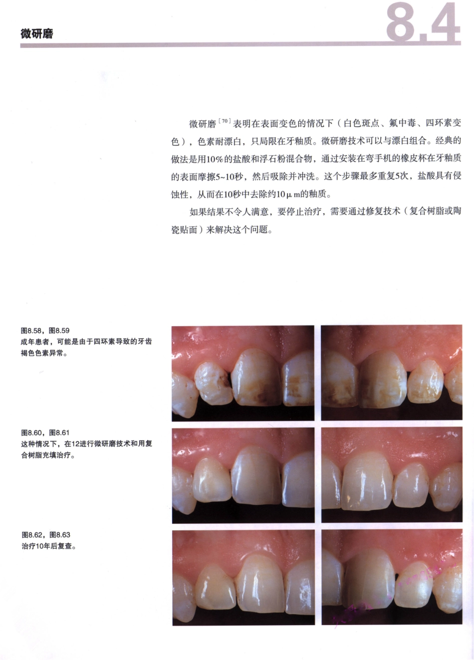 前牙微创美学修复（第2卷）_周锐2015（彩图）书签_346-360.pdf_第1页