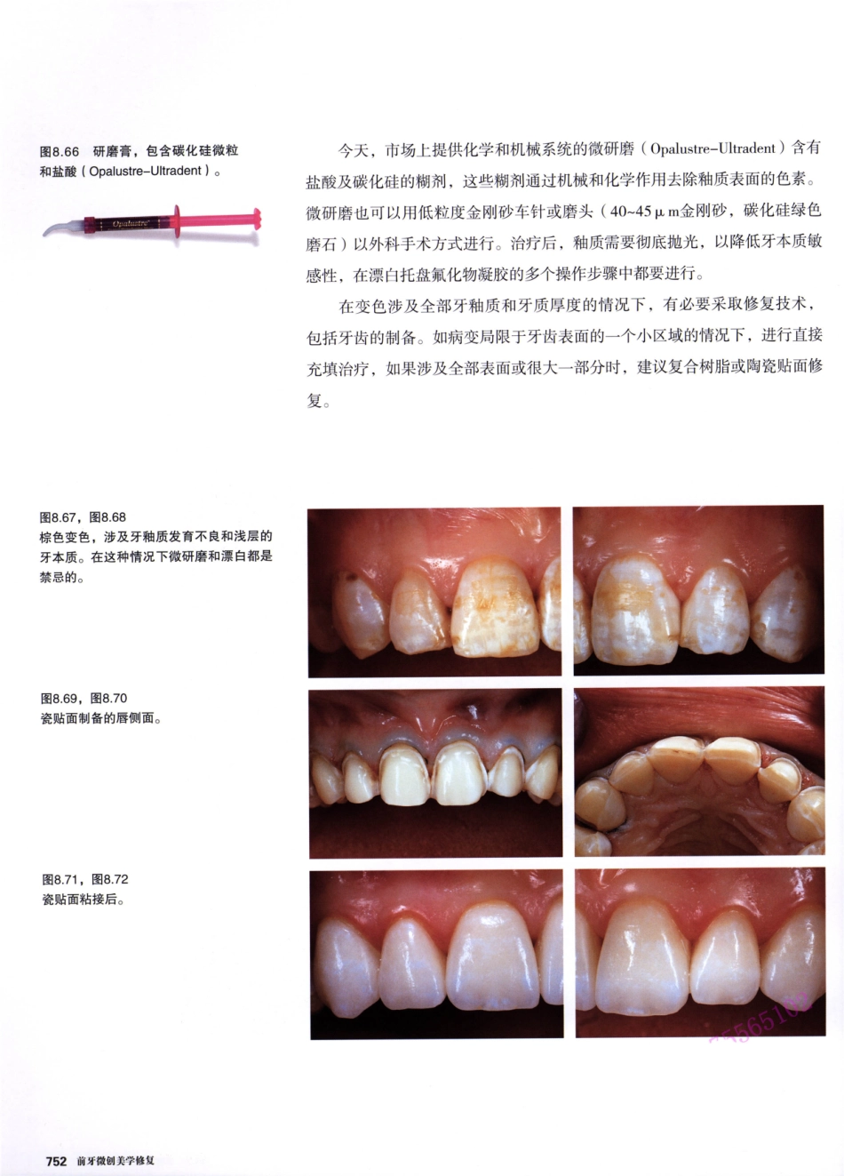 前牙微创美学修复（第2卷）_周锐2015（彩图）书签_346-360.pdf_第3页
