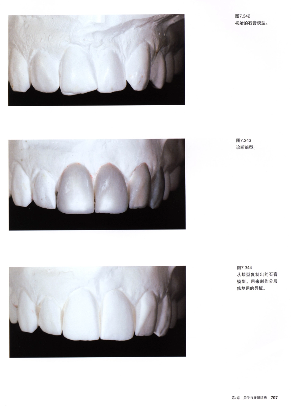 前牙微创美学修复（第2卷）_周锐2015（彩图）书签_301-315.pdf_第3页