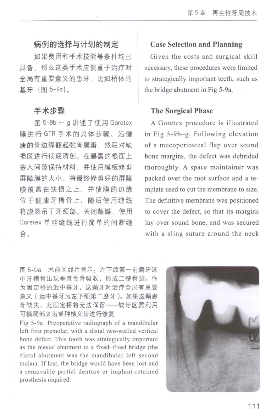 牙周手术临床指南 中英文对照_俞雪芬2013（彩图）_121-132.pdf_第1页