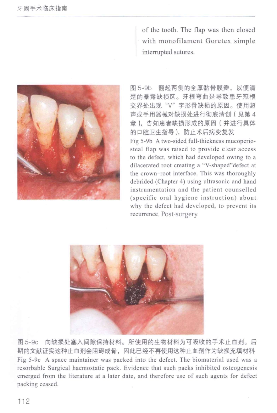 牙周手术临床指南 中英文对照_俞雪芬2013（彩图）_121-132.pdf_第2页