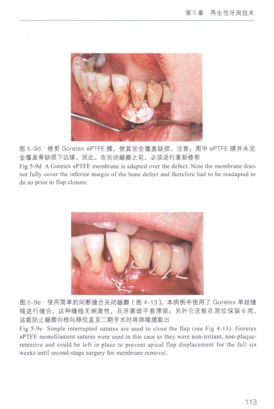 牙周手术临床指南 中英文对照_俞雪芬2013（彩图）_121-132.pdf_第3页