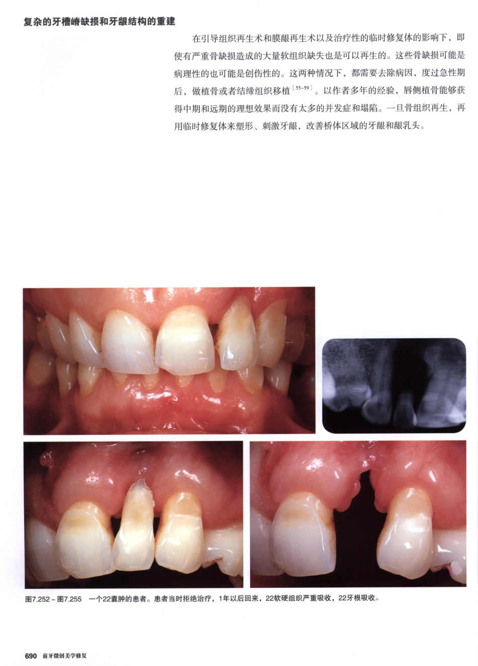 前牙微创美学修复（第2卷）_周锐2015（彩图）书签_286-300.pdf_第1页