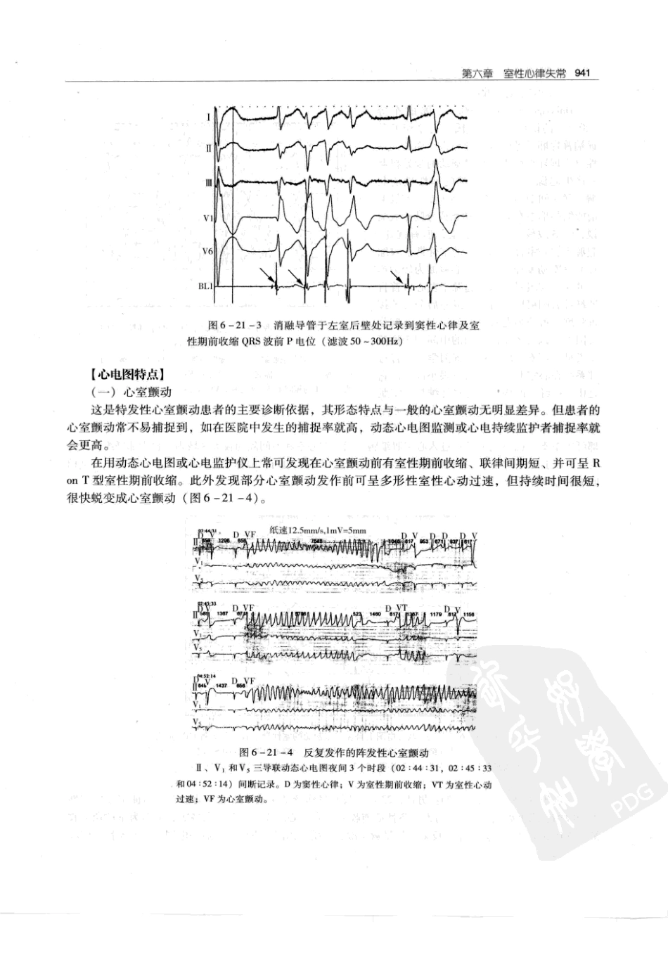 实用心律失常学：1100例心电图个案临床分析  第2版_中国协和医科大学出版社_2008.10_夏宏器，邓开伯主编_951-1000.pdf_第3页
