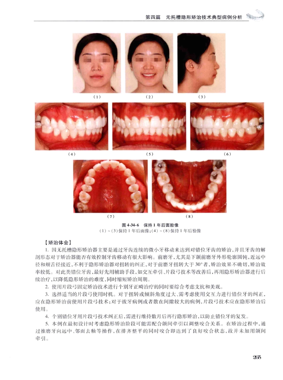 口腔正畸现代无托槽隐形矫治技术 田杰著 2014_277-288.pdf_第3页