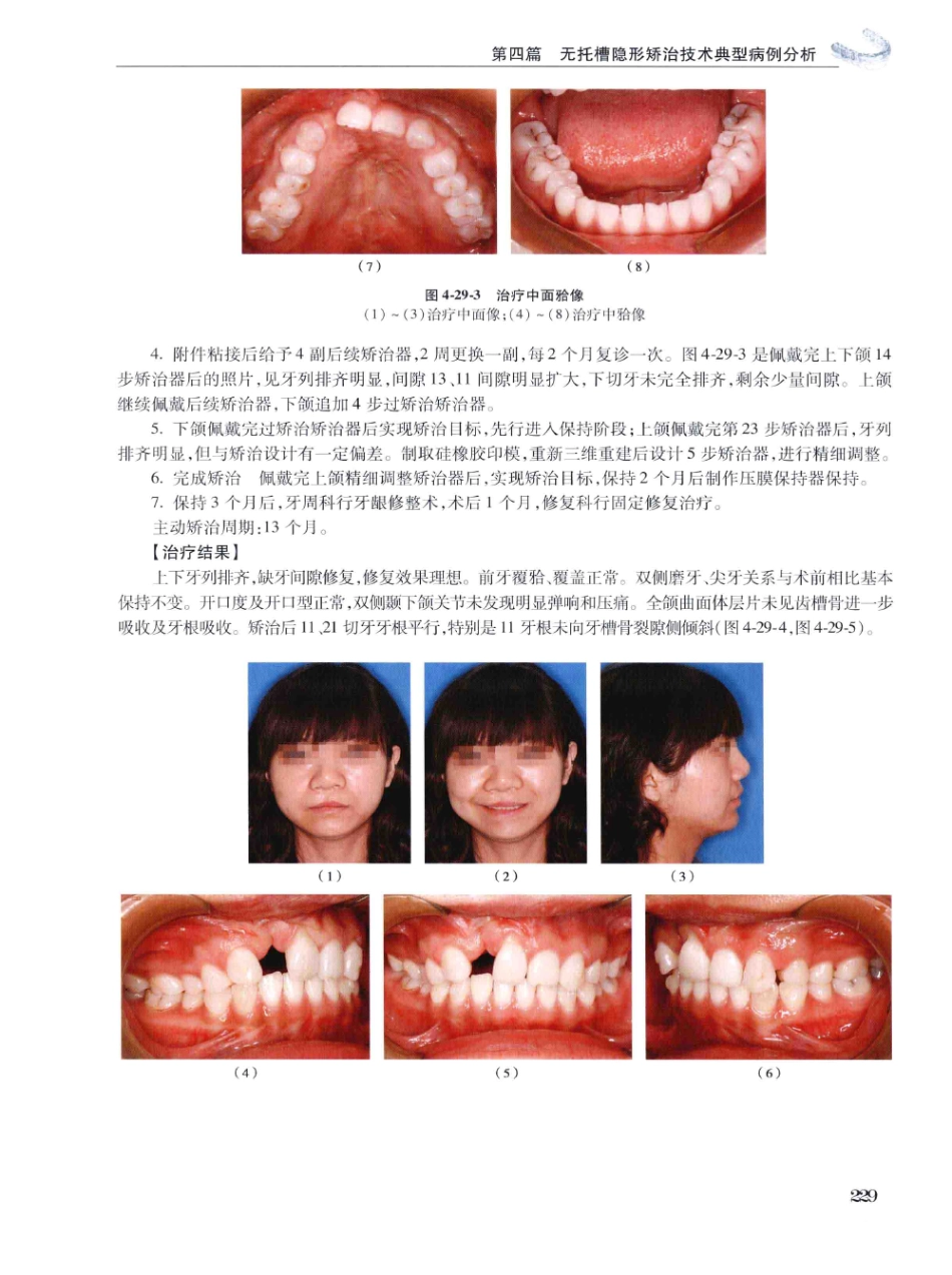 口腔正畸现代无托槽隐形矫治技术 田杰著 2014_241-252.pdf_第3页