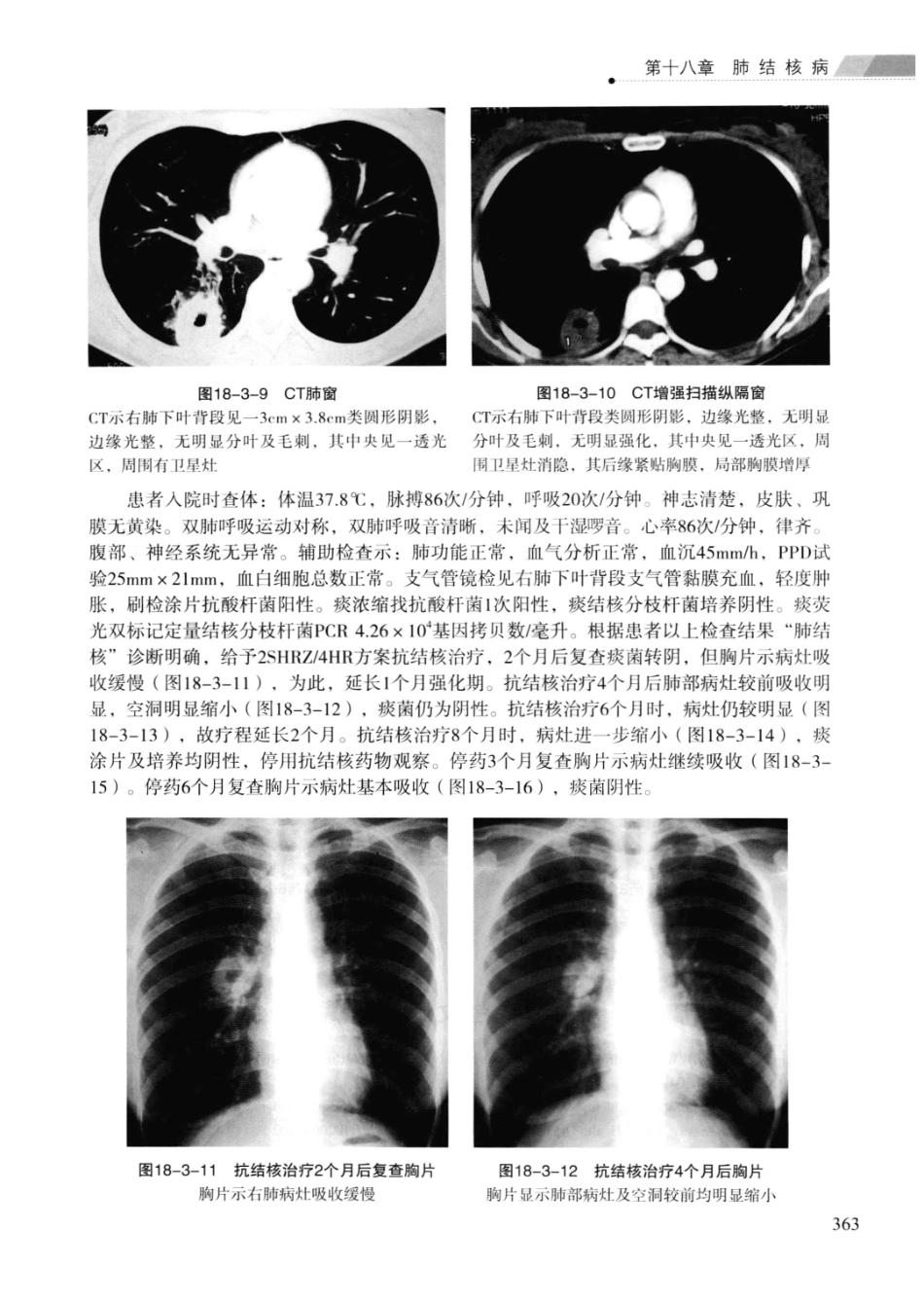 临床结核病学 （临床、影像、病例、误区及_13008036_376-400.pdf_第2页