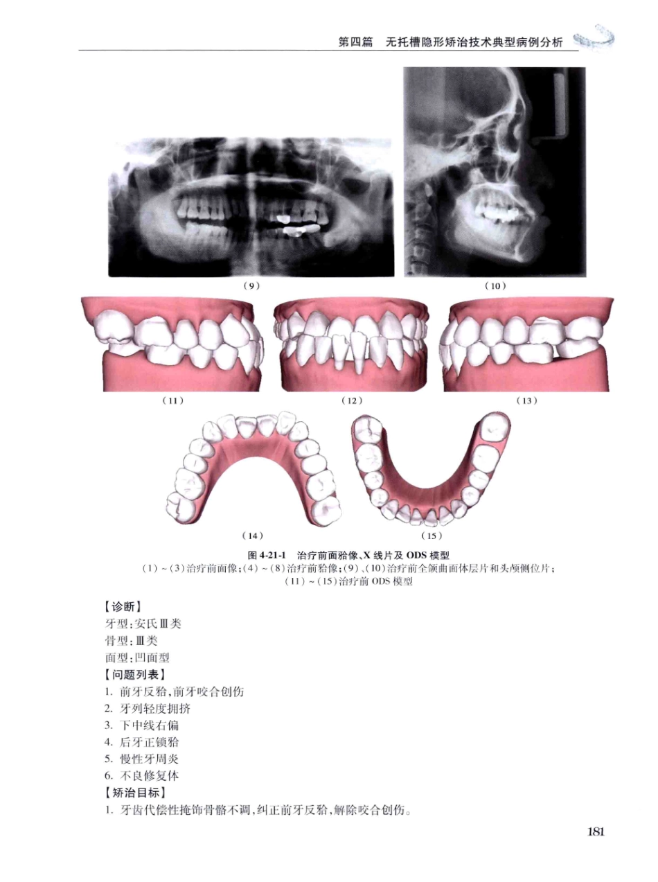 口腔正畸现代无托槽隐形矫治技术 田杰著 2014_193-204.pdf_第3页