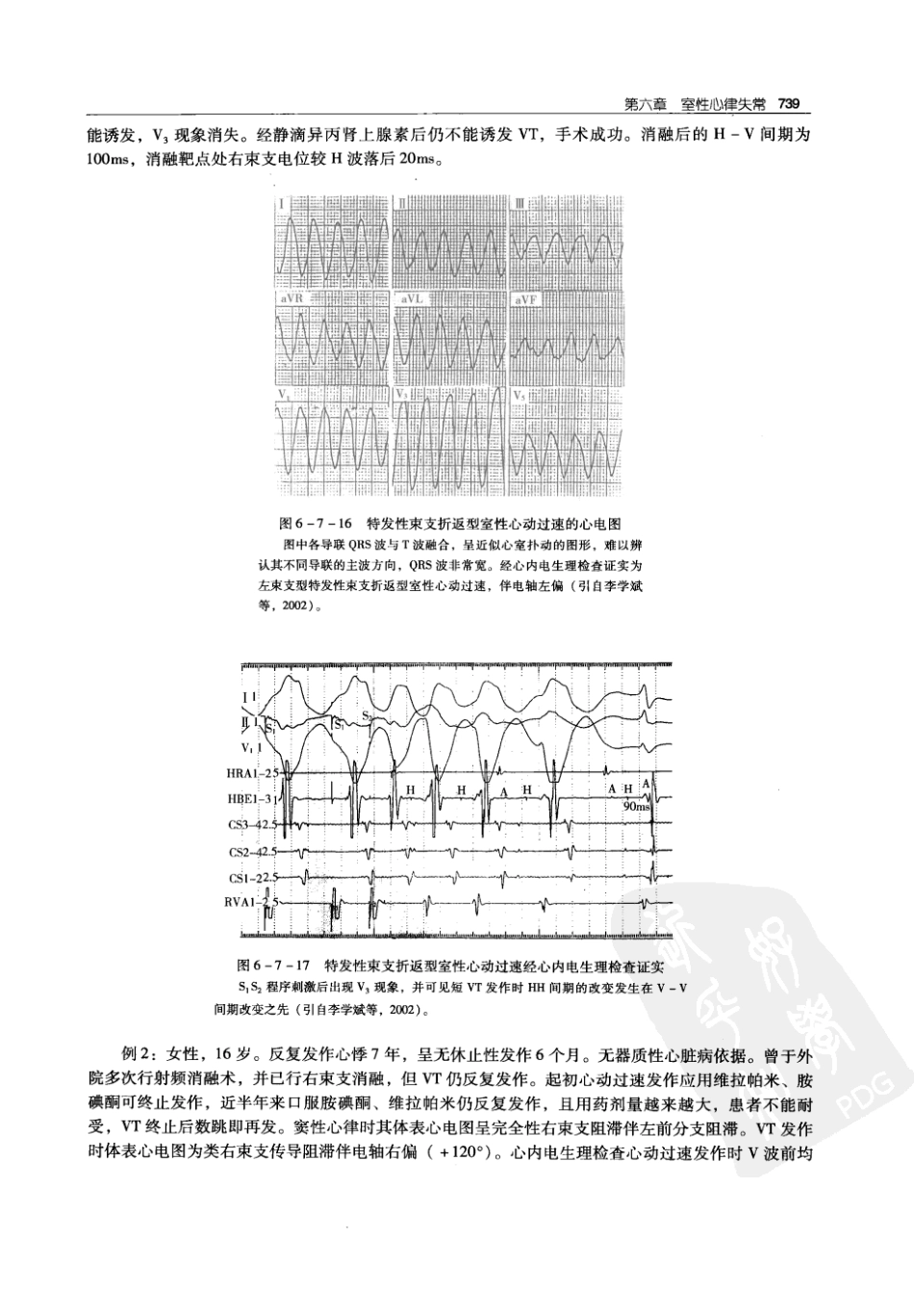 实用心律失常学：1100例心电图个案临床分析  第2版_中国协和医科大学出版社_2008.10_夏宏器，邓开伯主编_751-800.pdf_第1页