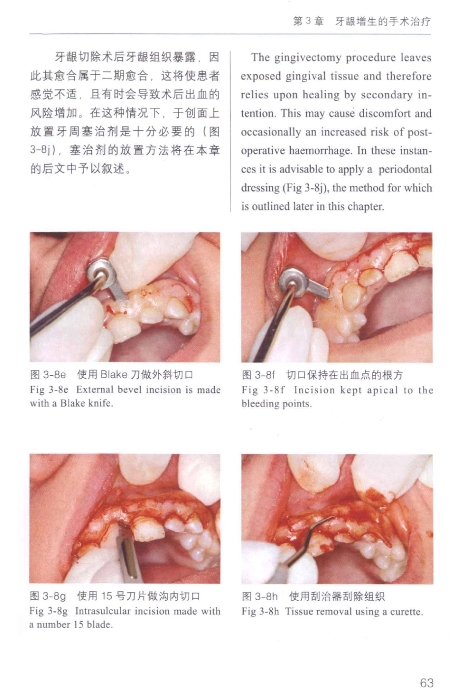 牙周手术临床指南 中英文对照_俞雪芬2013（彩图）_73-84.pdf_第1页