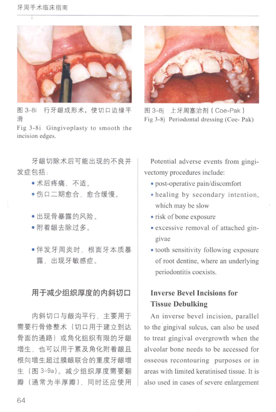 牙周手术临床指南 中英文对照_俞雪芬2013（彩图）_73-84.pdf_第2页