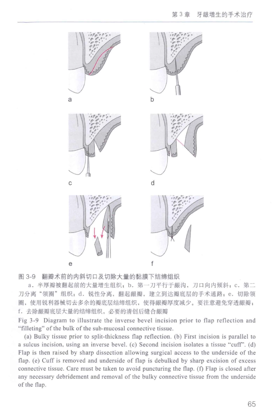 牙周手术临床指南 中英文对照_俞雪芬2013（彩图）_73-84.pdf_第3页