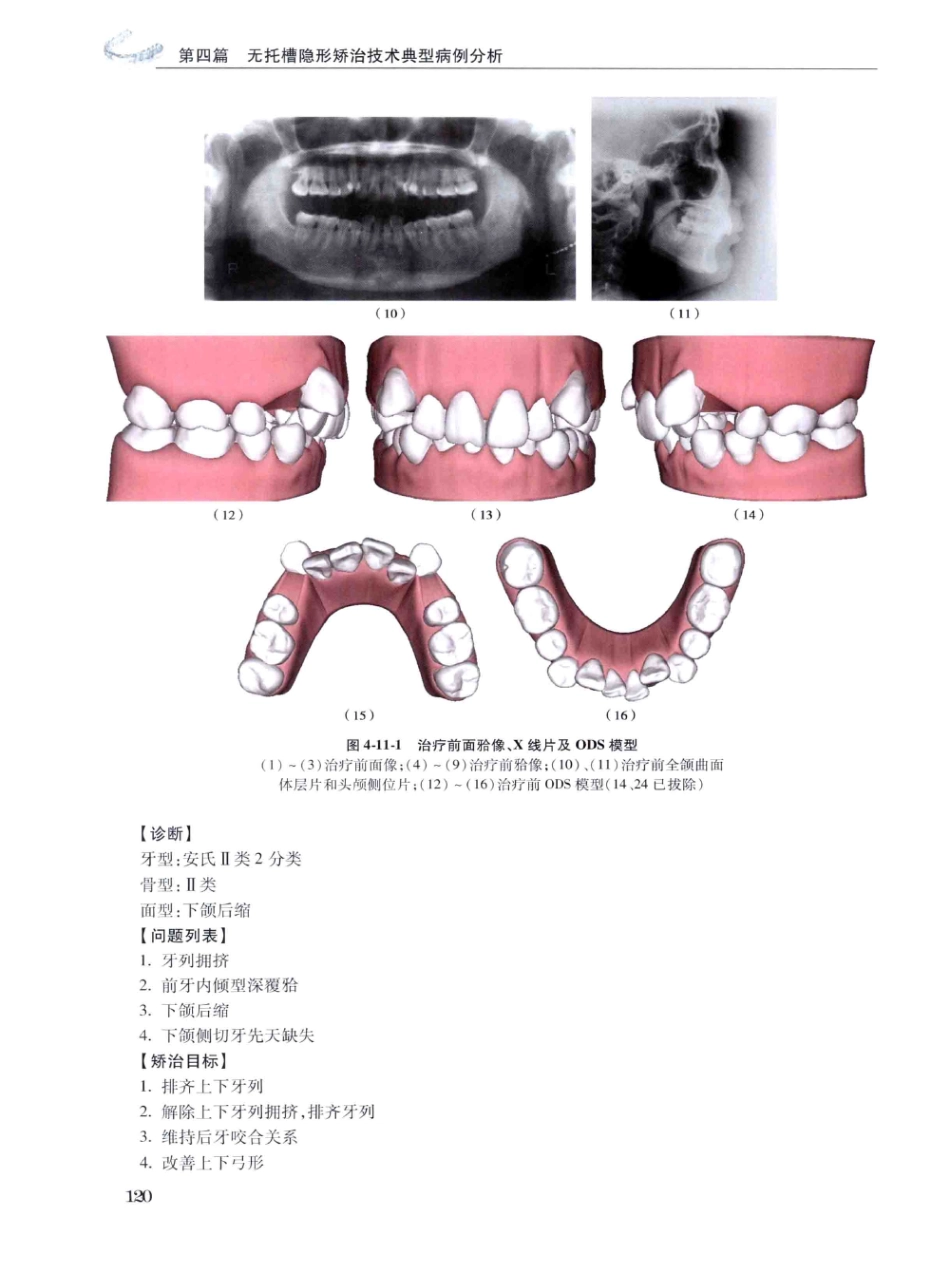 口腔正畸现代无托槽隐形矫治技术 田杰著 2014_133-144.pdf_第2页