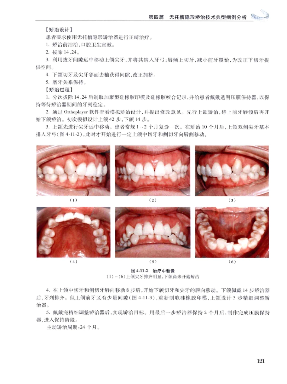 口腔正畸现代无托槽隐形矫治技术 田杰著 2014_133-144.pdf_第3页