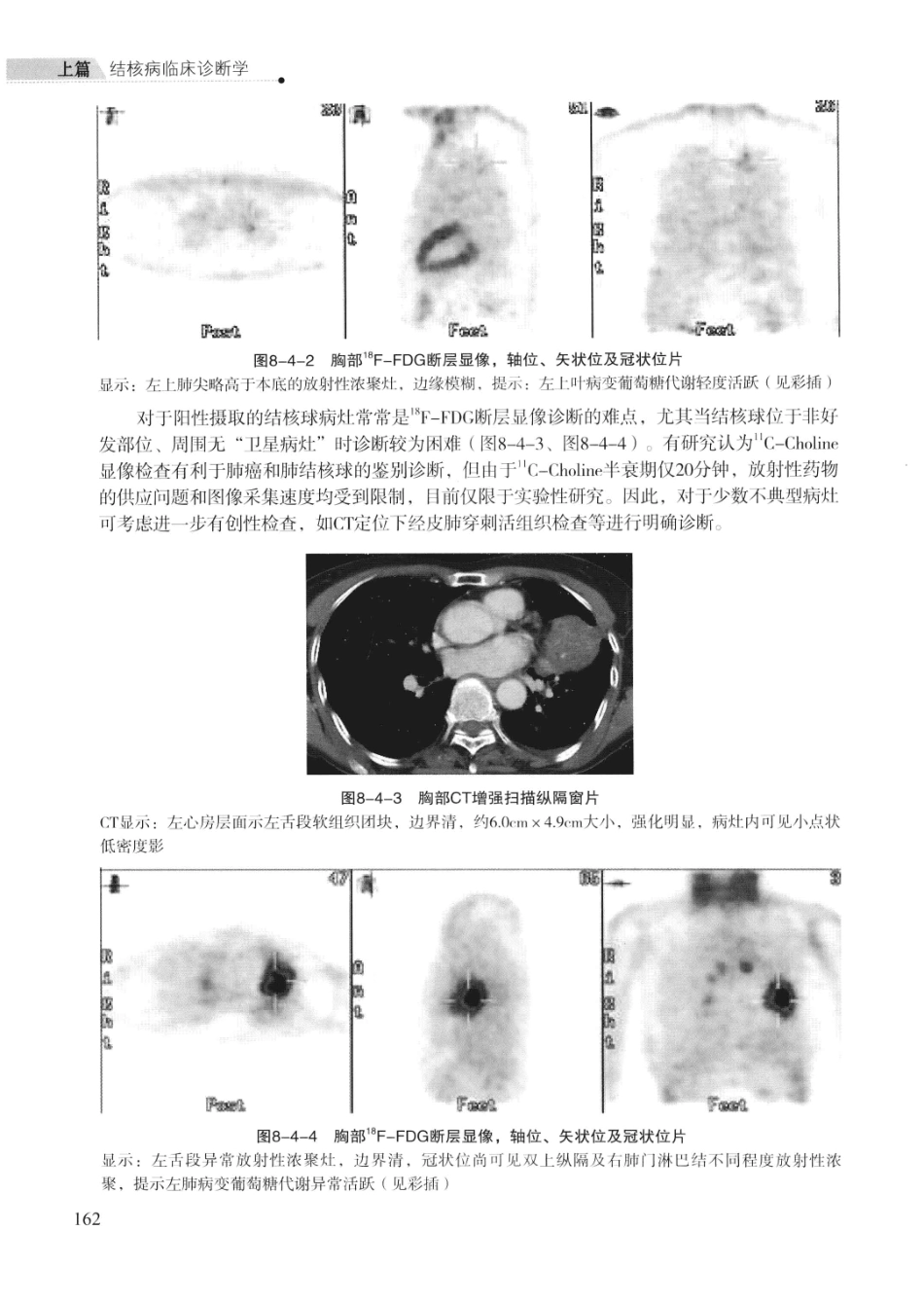 临床结核病学 （临床、影像、病例、误区及_13008036_176-200.pdf_第1页