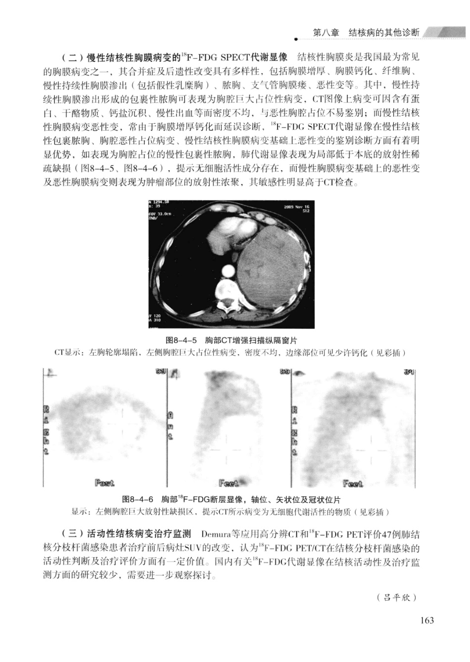 临床结核病学 （临床、影像、病例、误区及_13008036_176-200.pdf_第2页