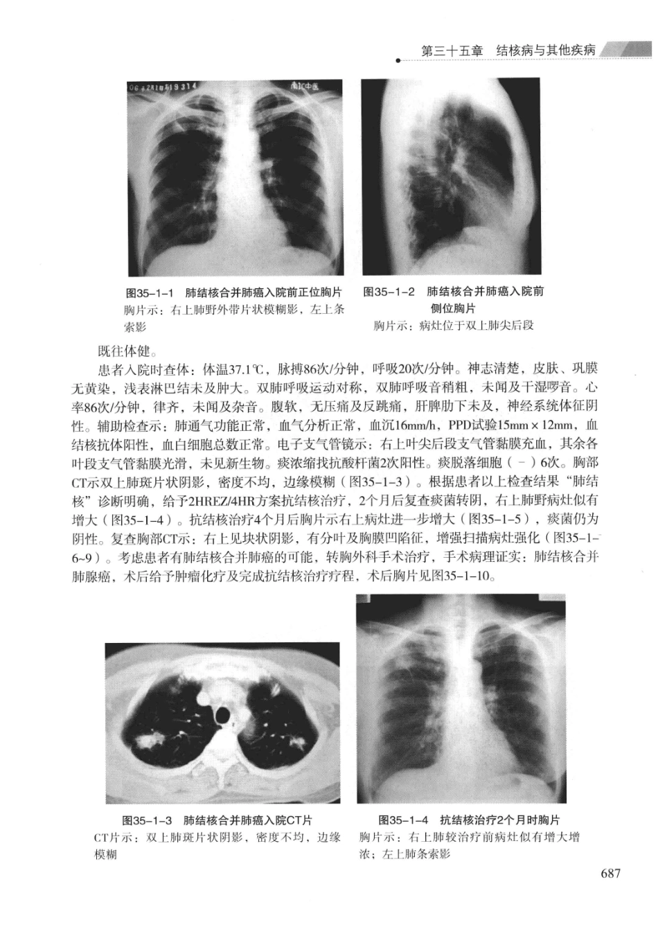 临床结核病学 （临床、影像、病例、误区及_13008036_701-723.pdf_第1页