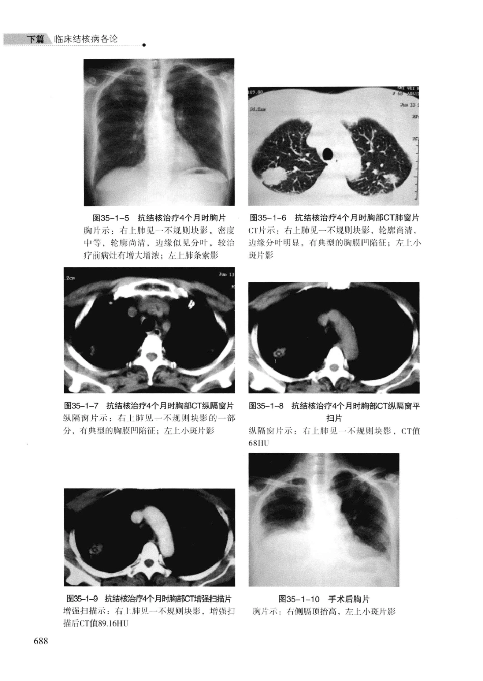临床结核病学 （临床、影像、病例、误区及_13008036_701-723.pdf_第2页
