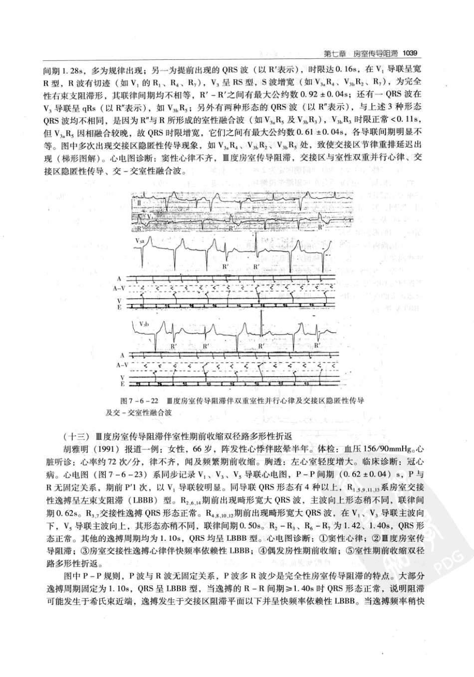 实用心律失常学：1100例心电图个案临床分析  第2版_中国协和医科大学出版社_2008.10_夏宏器，邓开伯主编_1051-1100.pdf_第1页