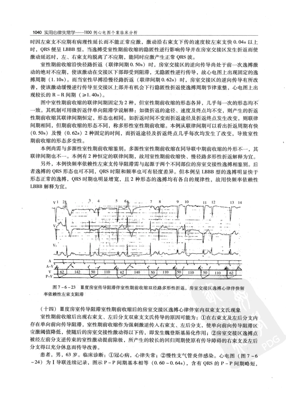 实用心律失常学：1100例心电图个案临床分析  第2版_中国协和医科大学出版社_2008.10_夏宏器，邓开伯主编_1051-1100.pdf_第2页