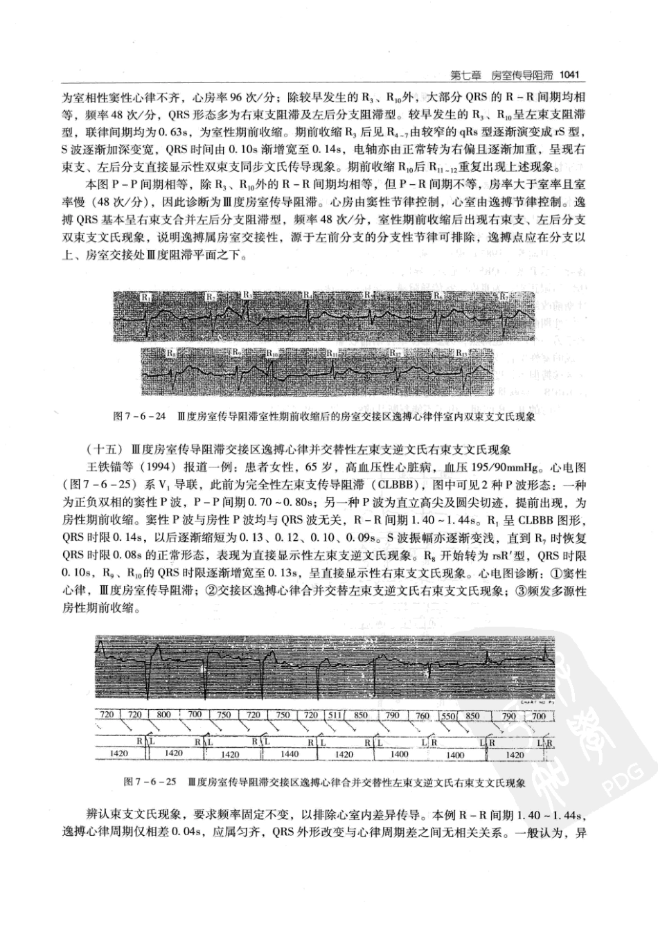 实用心律失常学：1100例心电图个案临床分析  第2版_中国协和医科大学出版社_2008.10_夏宏器，邓开伯主编_1051-1100.pdf_第3页