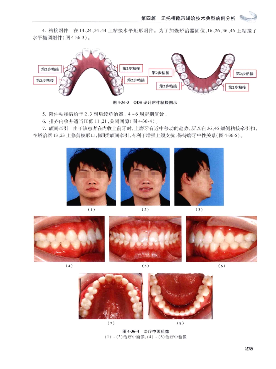 口腔正畸现代无托槽隐形矫治技术 田杰著 2014_289-300.pdf_第1页