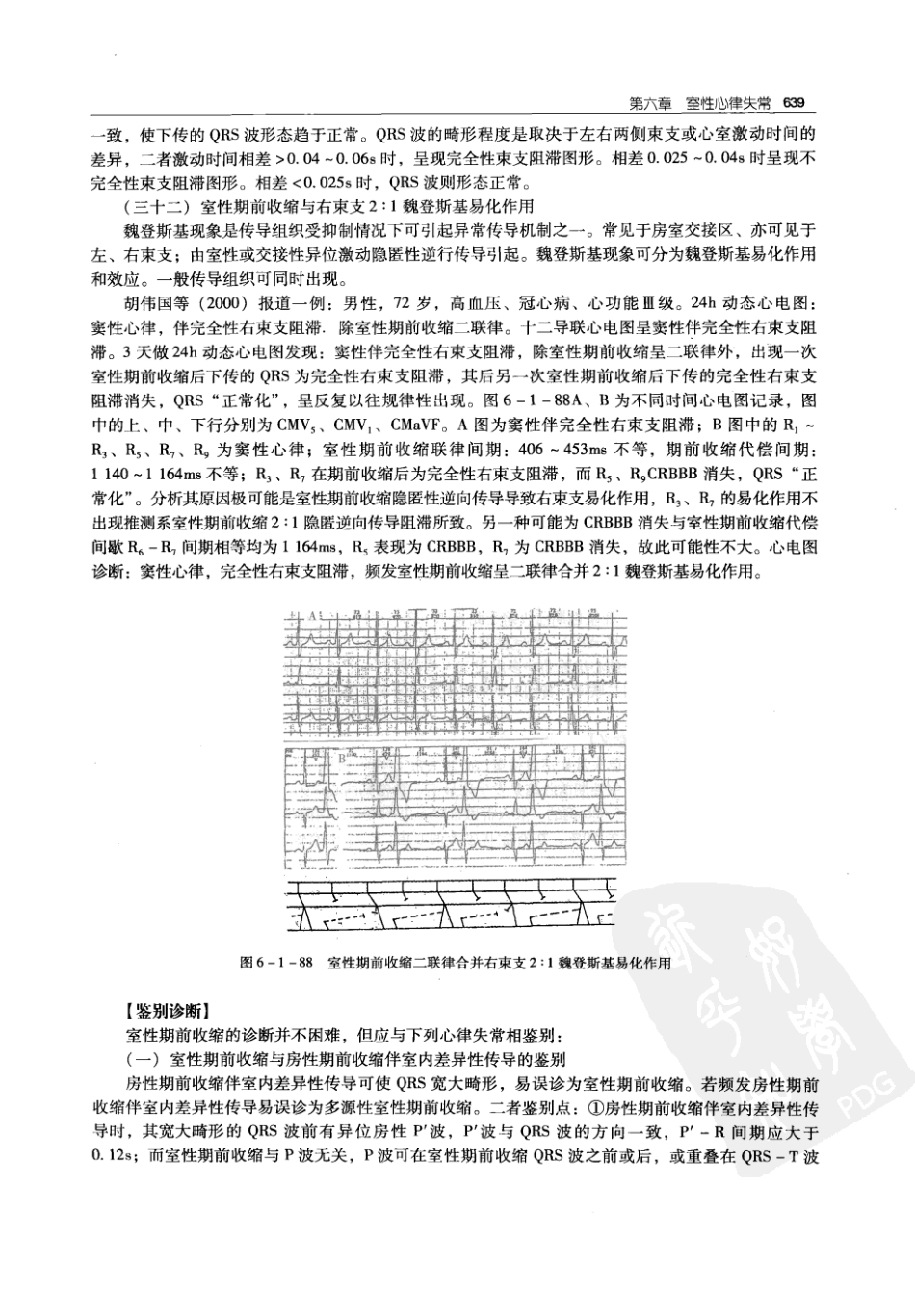 实用心律失常学：1100例心电图个案临床分析  第2版_中国协和医科大学出版社_2008.10_夏宏器，邓开伯主编_651-700.pdf_第1页