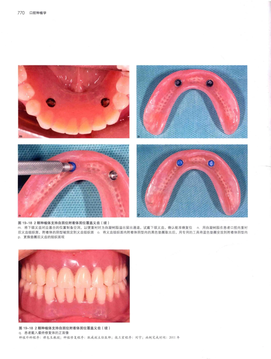 口腔种植学（第2版）_宿玉成主编_2014年（彩图）_811-840.pdf_第3页