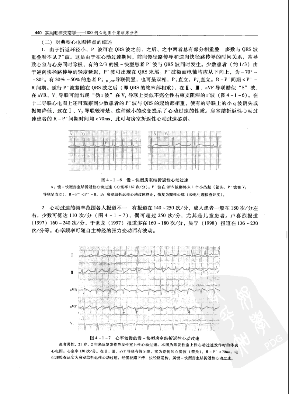 实用心律失常学：1100例心电图个案临床分析  第2版_中国协和医科大学出版社_2008.10_夏宏器，邓开伯主编_451-500.pdf_第2页