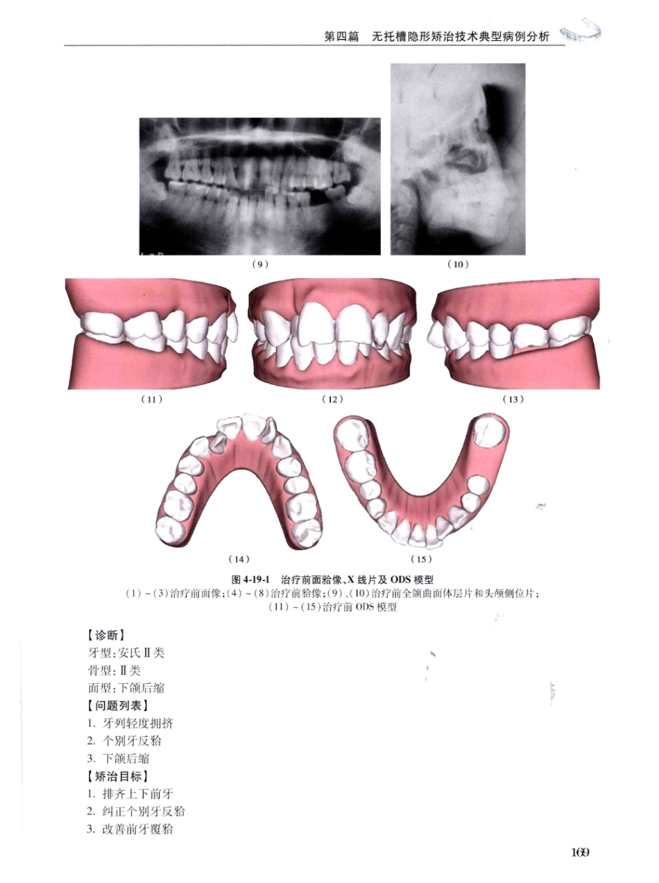 口腔正畸现代无托槽隐形矫治技术 田杰著 2014_181-192.pdf_第3页