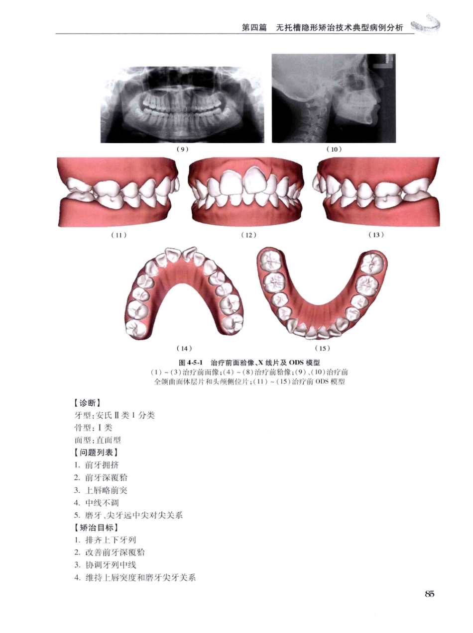 口腔正畸现代无托槽隐形矫治技术 田杰著 2014_97-108.pdf_第3页