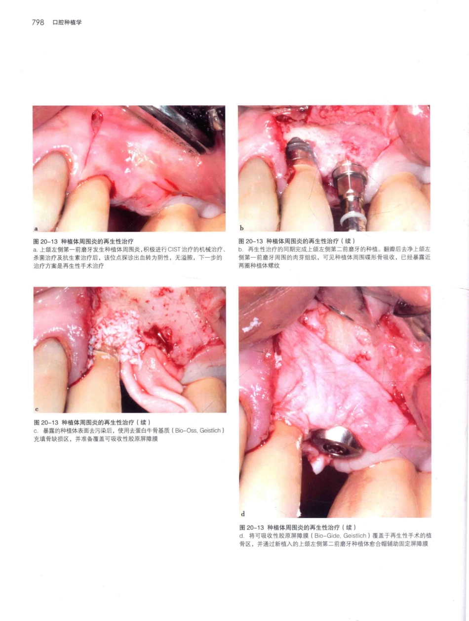 口腔种植学（第2版）_宿玉成主编_2014年（彩图）_841-870.pdf_第1页