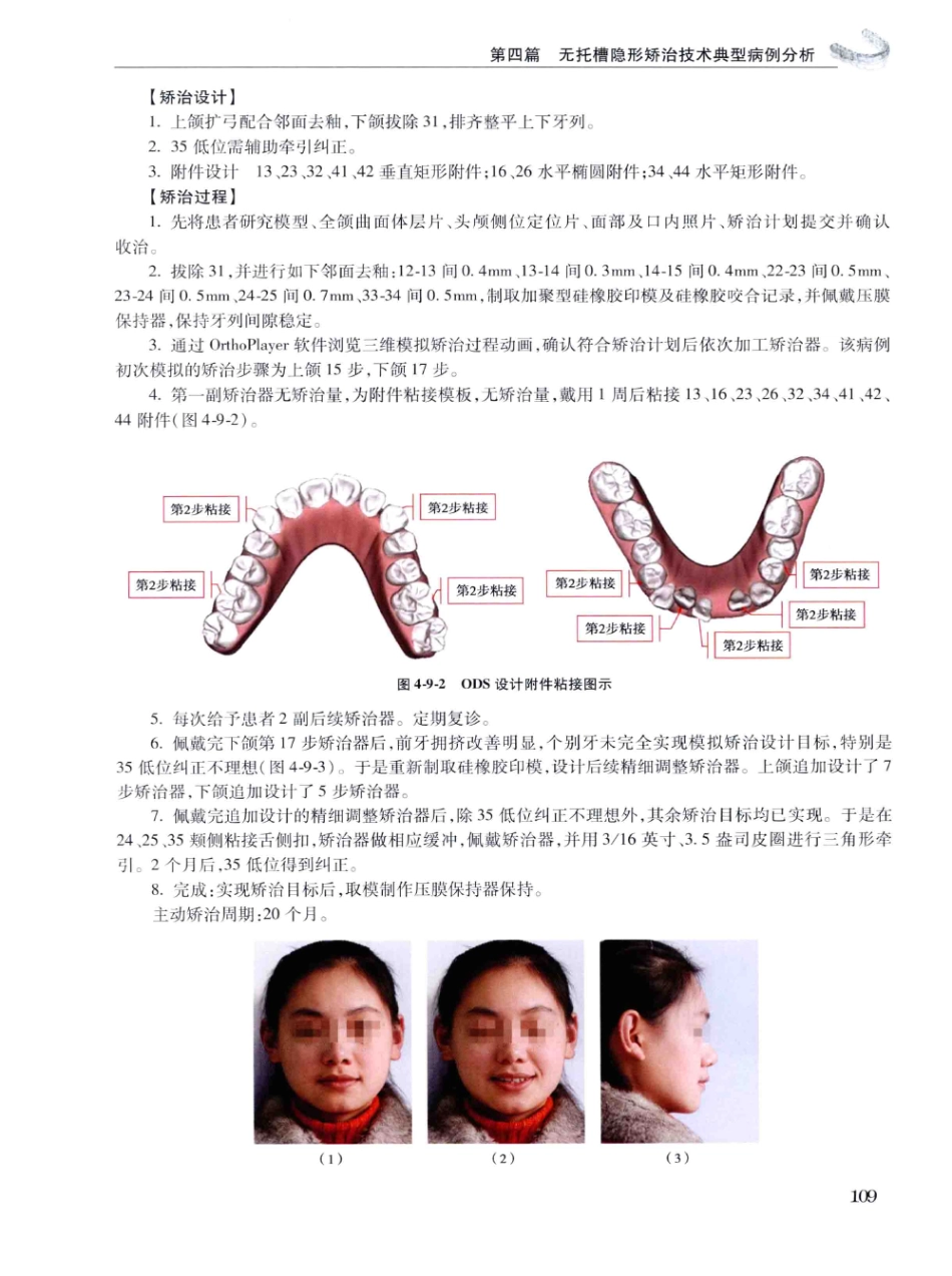 口腔正畸现代无托槽隐形矫治技术 田杰著 2014_121-132.pdf_第3页