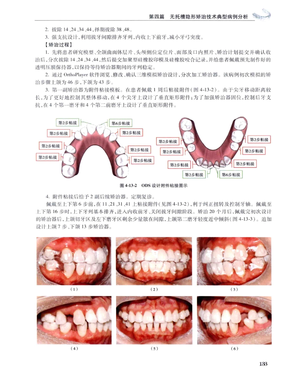 口腔正畸现代无托槽隐形矫治技术 田杰著 2014_145-156.pdf_第3页