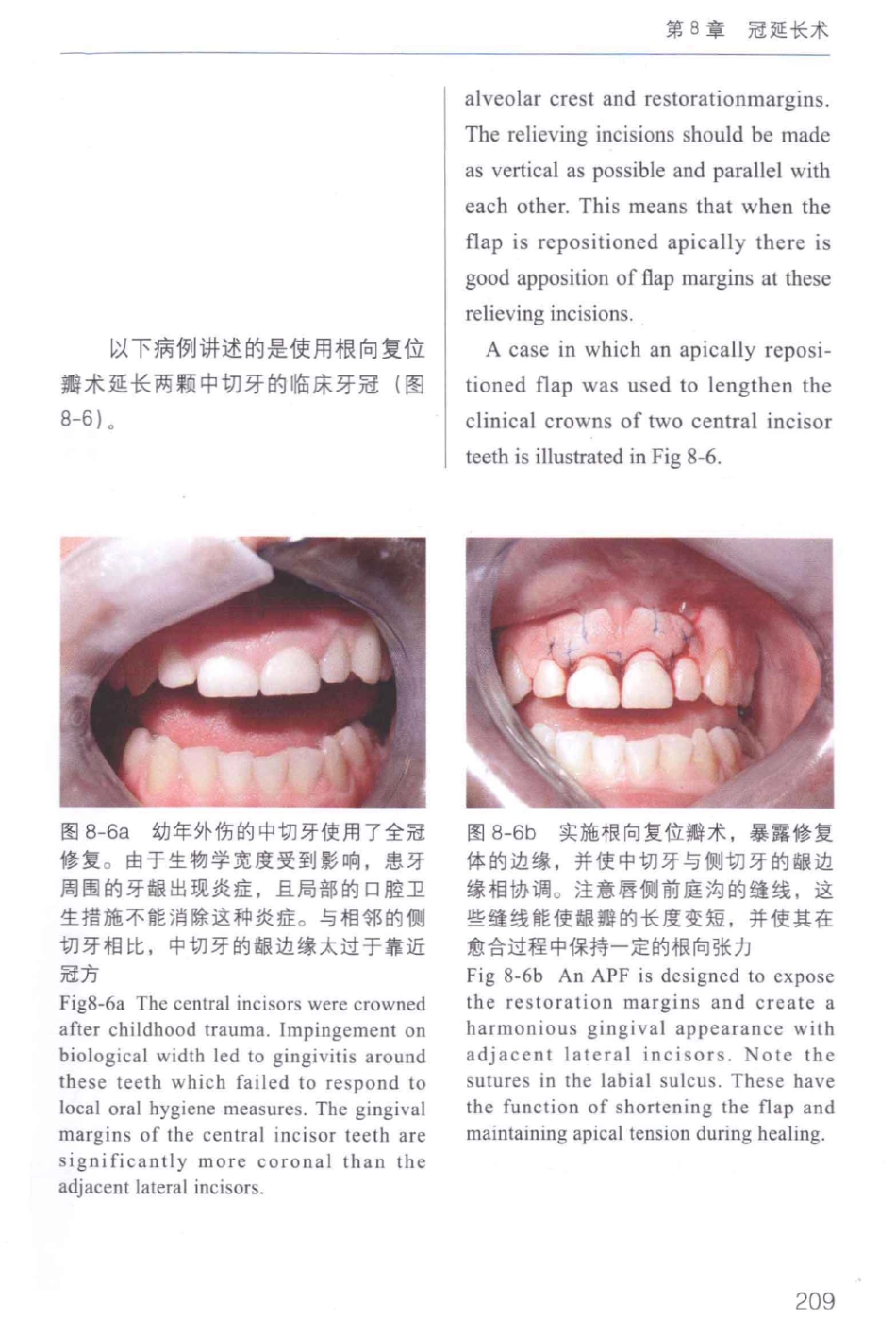 牙周手术临床指南 中英文对照_俞雪芬2013（彩图）_217-228.pdf_第3页