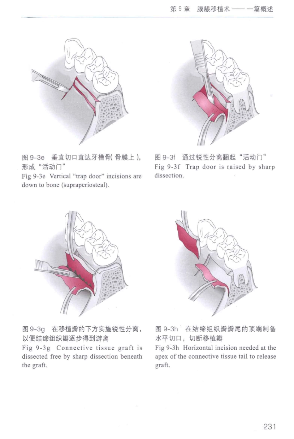 牙周手术临床指南 中英文对照_俞雪芬2013（彩图）_241-252.pdf_第1页