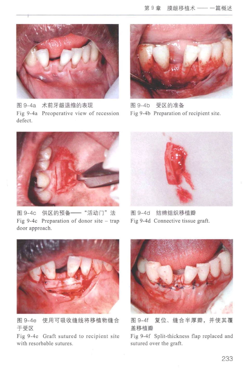 牙周手术临床指南 中英文对照_俞雪芬2013（彩图）_241-252.pdf_第3页