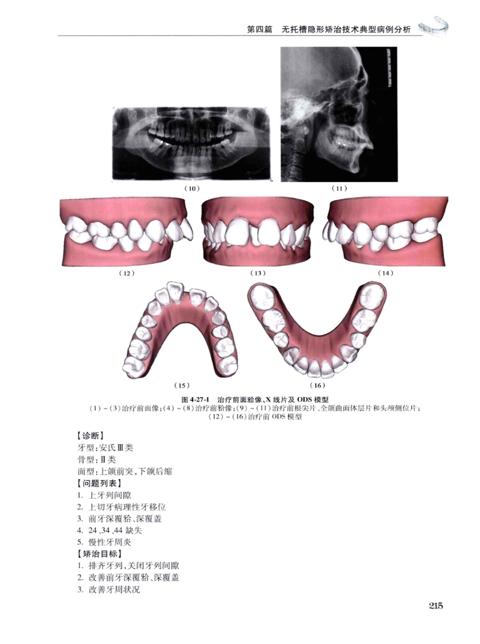 口腔正畸现代无托槽隐形矫治技术 田杰著 2014_229-240.pdf_第1页
