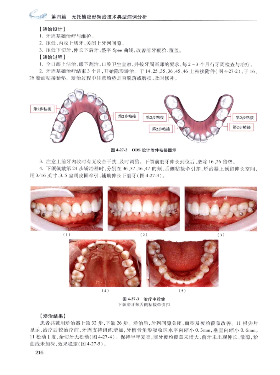 口腔正畸现代无托槽隐形矫治技术 田杰著 2014_229-240.pdf_第2页