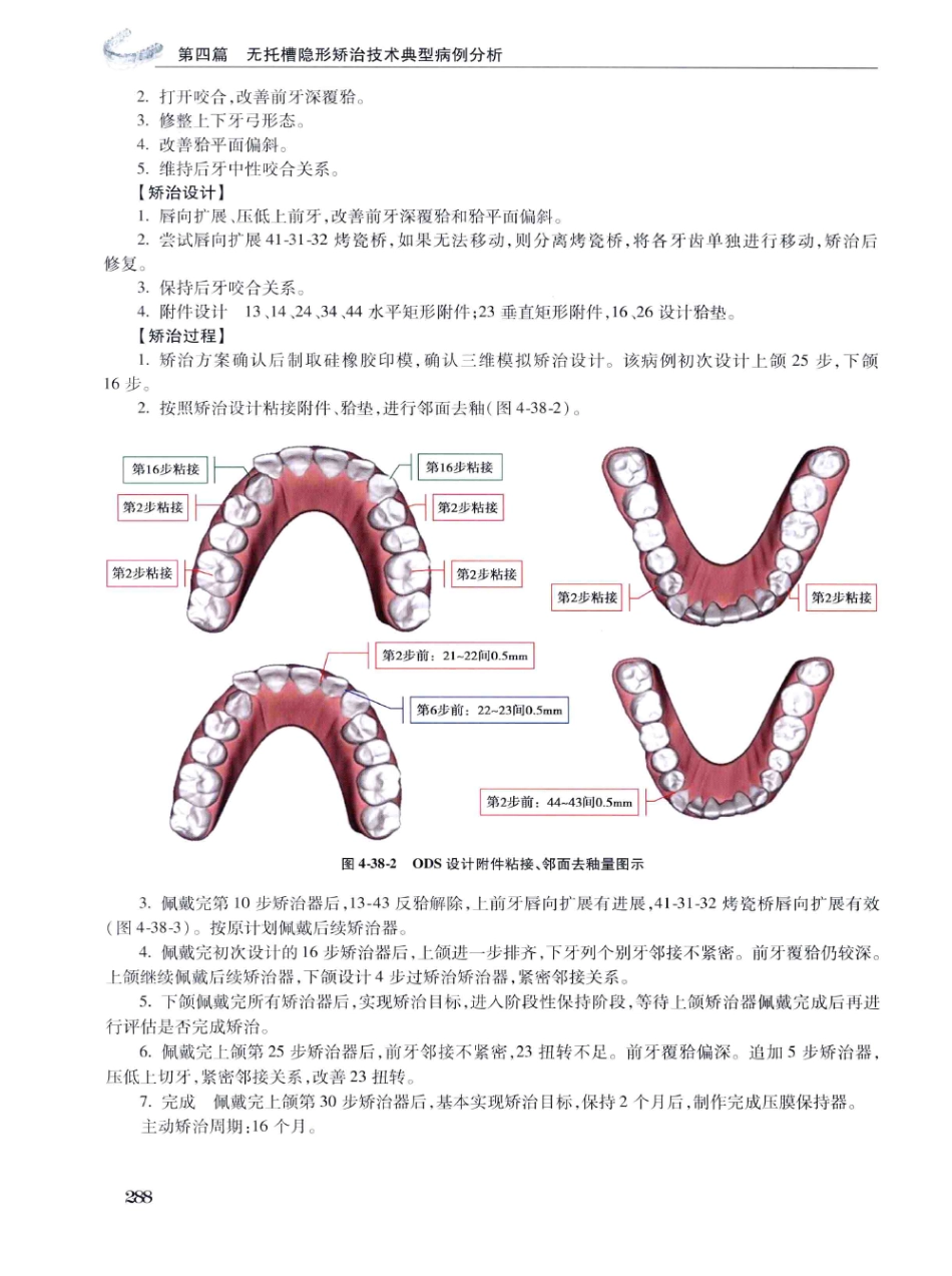 口腔正畸现代无托槽隐形矫治技术 田杰著 2014_301-312.pdf_第2页